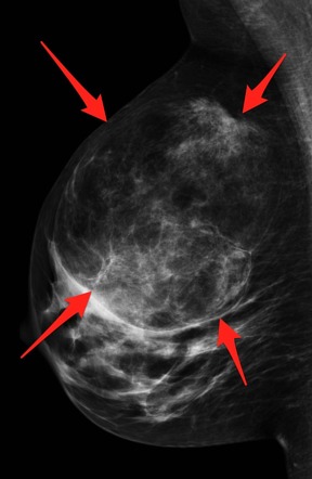 Breast Hamartoma Radiology Reference Article Radiopaedia Org