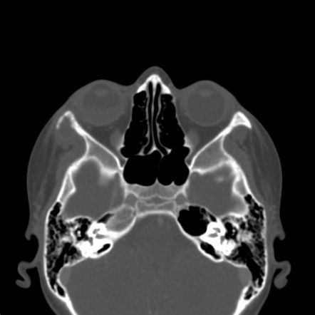 Orbital paracoccidioidomycosis | Image | Radiopaedia.org