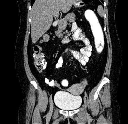 Ulcerative colitis | Radiology Case | Radiopaedia.org