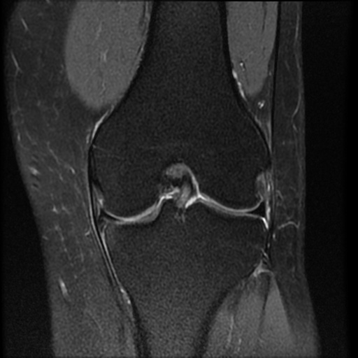 Displaced horizontal flap tear medial meniscal body | Image ...