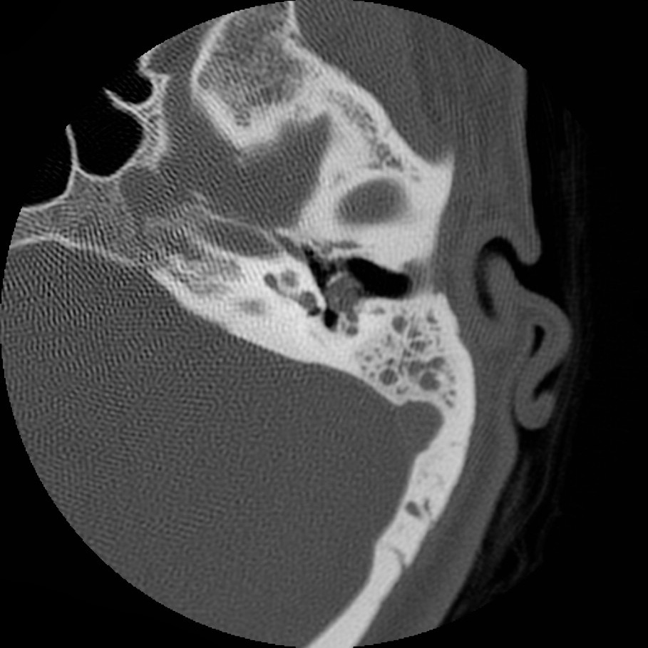 Холеастома. Холестеатома височной кости. Холестеатома височной кости кт. Холестеатома среднего уха на кт.