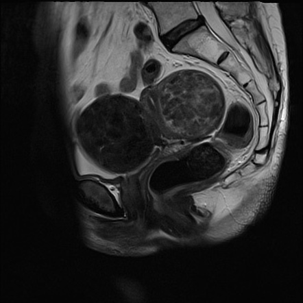 case study on fibroid uterus