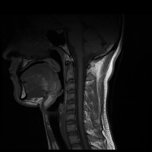 Cervical spine meningioma | Image | Radiopaedia.org