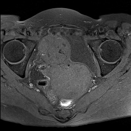 Fibroid uterus | Image | Radiopaedia.org