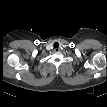 Viewing playlist: Normal Chest x-ray & CT | Radiopaedia.org