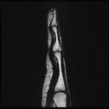 Trigger finger | Radiology Case | Radiopaedia.org