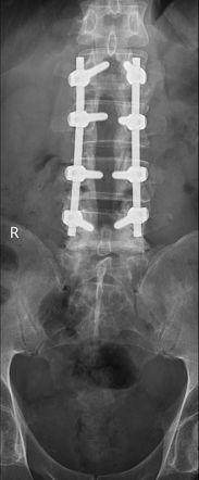 Laminectomy | Radiology Reference Article | Radiopaedia.org