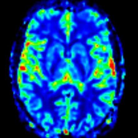 Dysembryoplastic neuroepithelial tumor (DNET) | Image | Radiopaedia.org