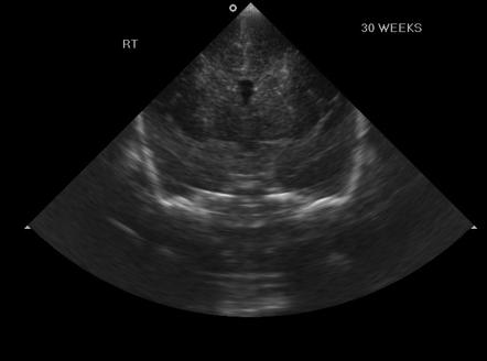 Mineralizing vasculopathy | Image | Radiopaedia.org