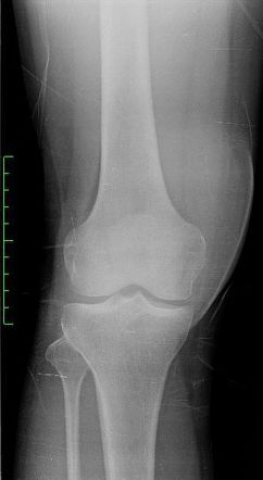 Prepatellar bursitis | Image | Radiopaedia.org