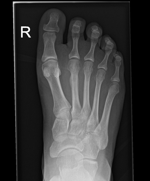 metatarsal stress fracture mri