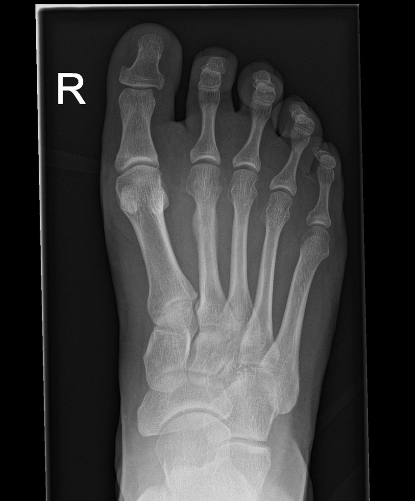 Xray Of Foot Stress Fracture