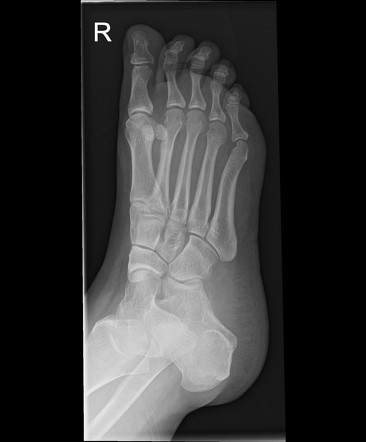 Stress fracture of second metatarsal | Image | Radiopaedia.org