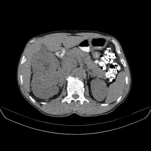 Renal cell carcinoma with extension into the IVC | Image | Radiopaedia.org