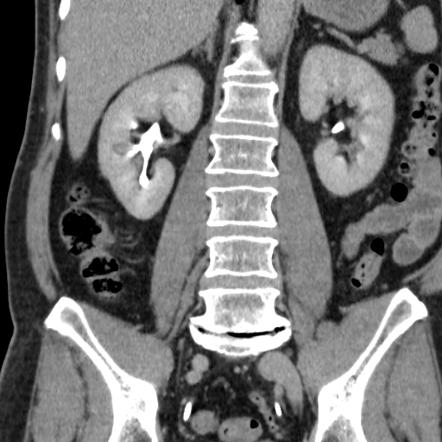 Milk of calcium renal cyst | Image | Radiopaedia.org