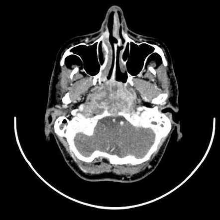 Nasopharyngeal Carcinoma Image Radiopaediaorg