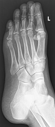 Distal phalanx fracture | Radiology Reference Article | Radiopaedia.org