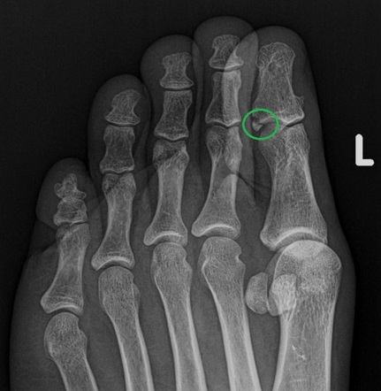 Fracture distal phalanx of great toe | Radiology Case | Radiopaedia.org