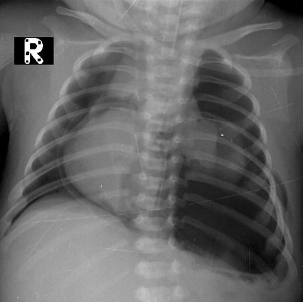 Tension pneumothorax and pneumomediastinum | Radiology Case ...