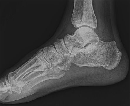 Lover's fracture | Radiology Reference Article | Radiopaedia.org