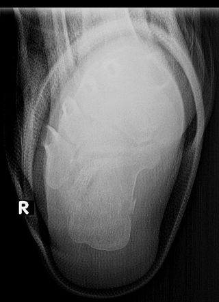 Lover's fracture | Image | Radiopaedia.org