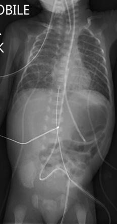 Neonatal bowel perforation | Radiology Case | Radiopaedia.org