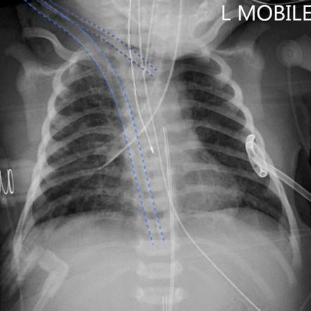 ECMO catheters in a neonate | Image | Radiopaedia.org