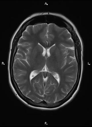 Cerebral arteriovenous malformation | Image | Radiopaedia.org