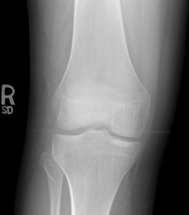 ACL avulsion with fibula fractures | Radiology Case | Radiopaedia.org