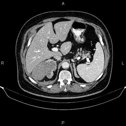 Adrenal hemorrhage | Radiology Reference Article | Radiopaedia.org