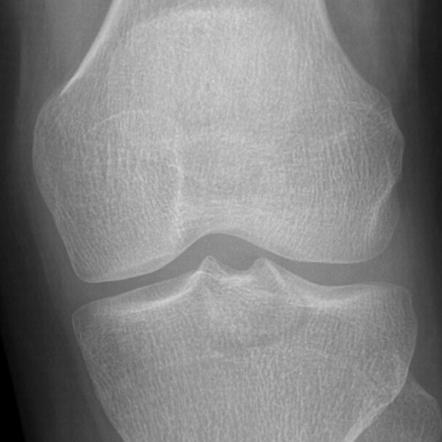 PCL avulsion fracture | Image | Radiopaedia.org