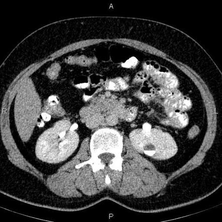 Renal milk of calcium cyst | Image | Radiopaedia.org