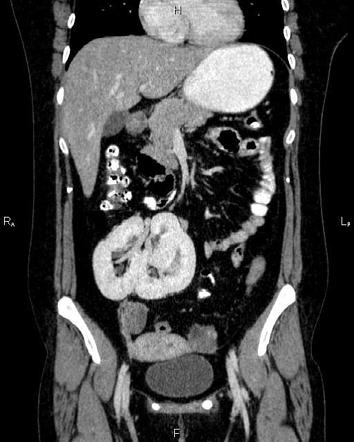 Pancake kidney | Radiology Case | Radiopaedia.org