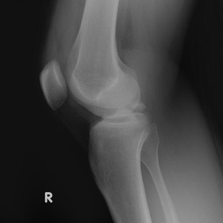 Posterior Cruciate Ligament Avulsion Fracture Radiology Reference Article Radiopaedia Org