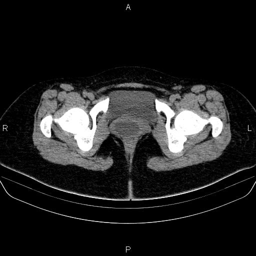 Bartholin gland cyst | Image | Radiopaedia.org