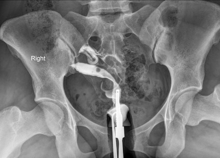 Unicornuate uterus | Radiology Case | Radiopaedia.org