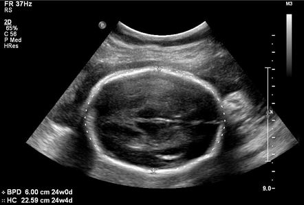 Severe IUGR with critical dopplers | Radiology Case | Radiopaedia.org