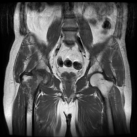 Avascular necrosis and bone infarct - proximal femur | Image ...