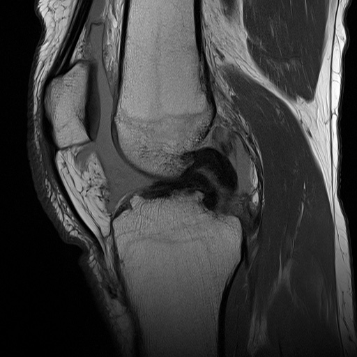 ACL tear with Wrisberg rip and bucket handle tear | Image | Radiopaedia.org