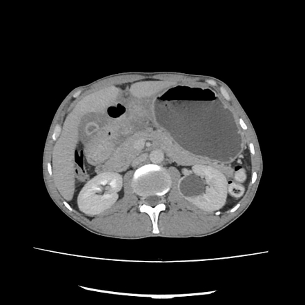 Perforated Gastric Ulcer With Abscess Formation | Radiology Case ...