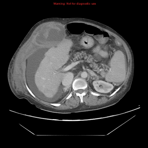 Abdominal Wall Hematoma Image Radiopaedia Org