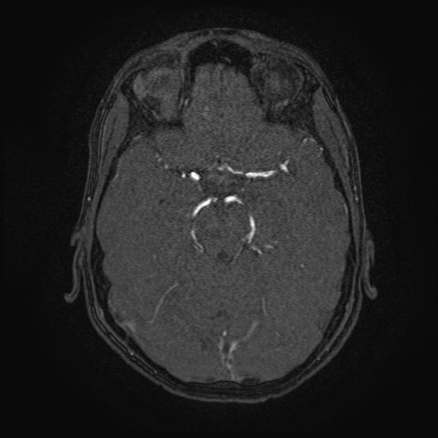 Central nervous system vasculitis | Radiology Reference Article 