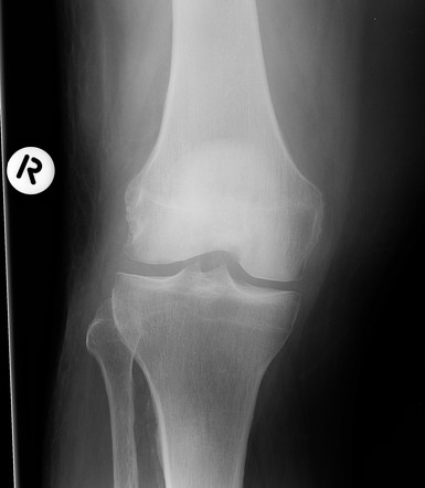 Gout - both knees (MRI) | Radiology Case | Radiopaedia.org