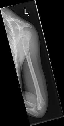 Simple bone cyst and pathological fracture | Radiology Case ...