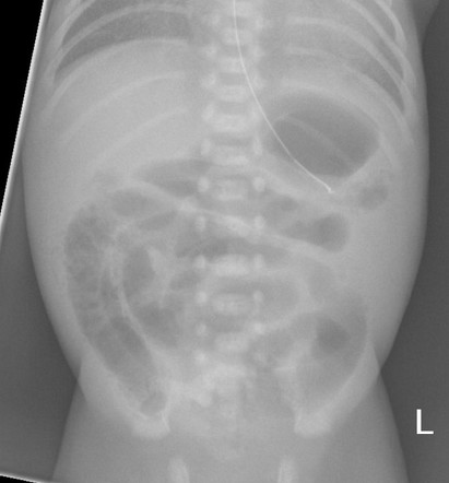 Necrotizing enterocolitis | Radiology Case | Radiopaedia.org