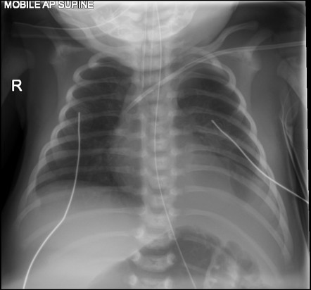 Congenital diaphragmatic hernia | Radiology Case | Radiopaedia.org