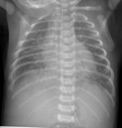 Meconium aspiration | Radiology Case | Radiopaedia.org