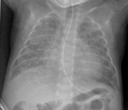 Respiratory distress syndrome and chronic lung disease of prematurity ...