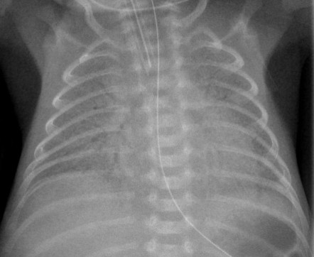 Respiratory distress syndrome | Radiology Case | Radiopaedia.org