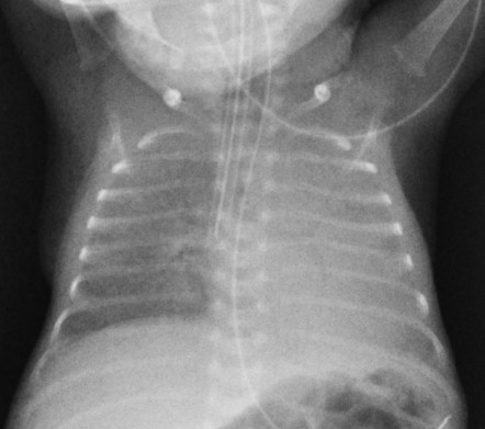 Respiratory distress syndrome and malpositioned ET tube | Radiology ...